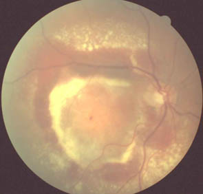 Extensive Retinal Haemorrhaging in Diabetic Retinopathy